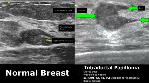 It develops when cells in the breast grow out of control and form tumors. . Breast ultrasound reddit
